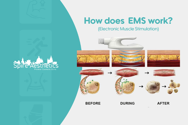 EMS treatment for post pregnancy weight loss treatment Underwood