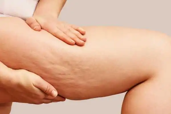 Image of woman showing leg with cellulite Underwood