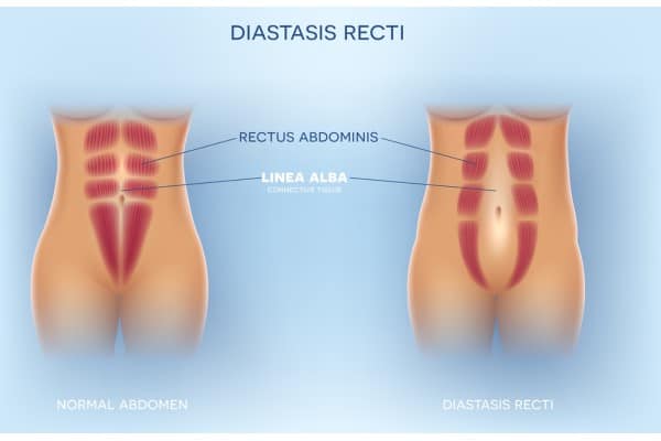 What Non-Surgical Options Are Available for Diastasis Recti Underwood?