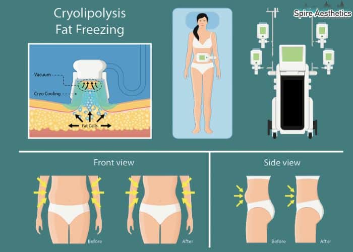 Image of diet and fat freezing combined for best results for Spire Aesthetics Underwood