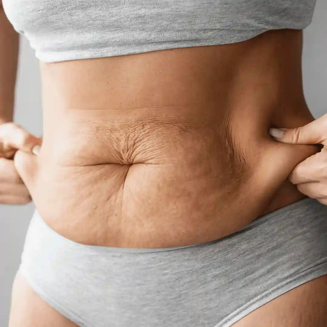Is It Normal to Have Loose Skin After Pregnancy Underwood?