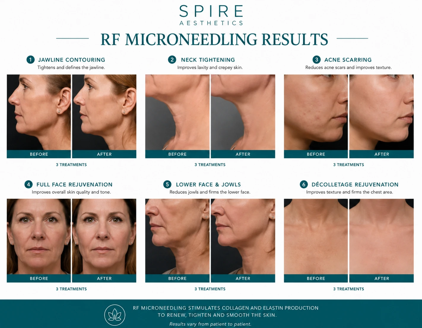 RF Microneedling Skin tightening Underwood results