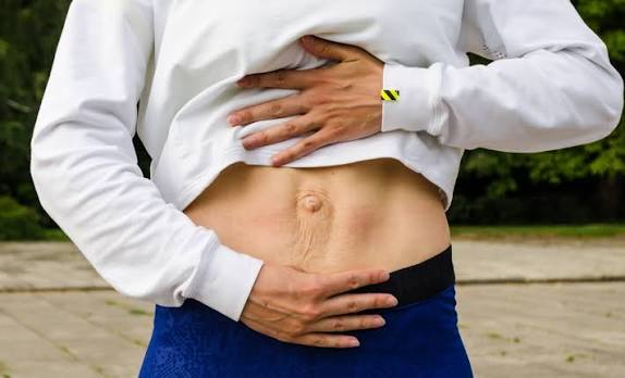 When Could Diastasis Recti Be the Missing Piece of the Puzzle Underwood?