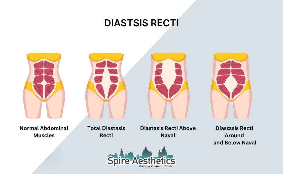 Is Non-Surgical Diastasis Recti Treatment Right for You? Common Concerns Answered Underwood